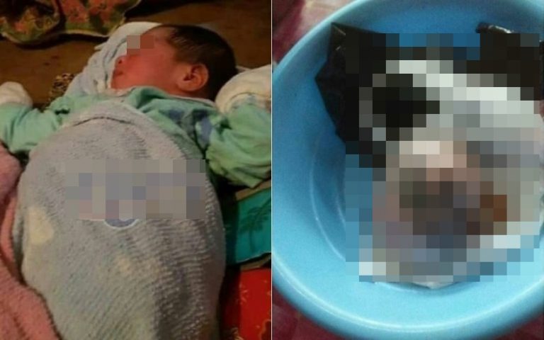 Lahirkan anak kembar salah satu bayi ibu ini hanya berkepala dan tidak memiliki badan