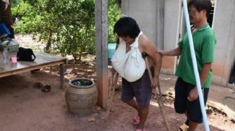 Alami kondisi langka payudara wanita asal Thailand ini tumbuh tak terkendali